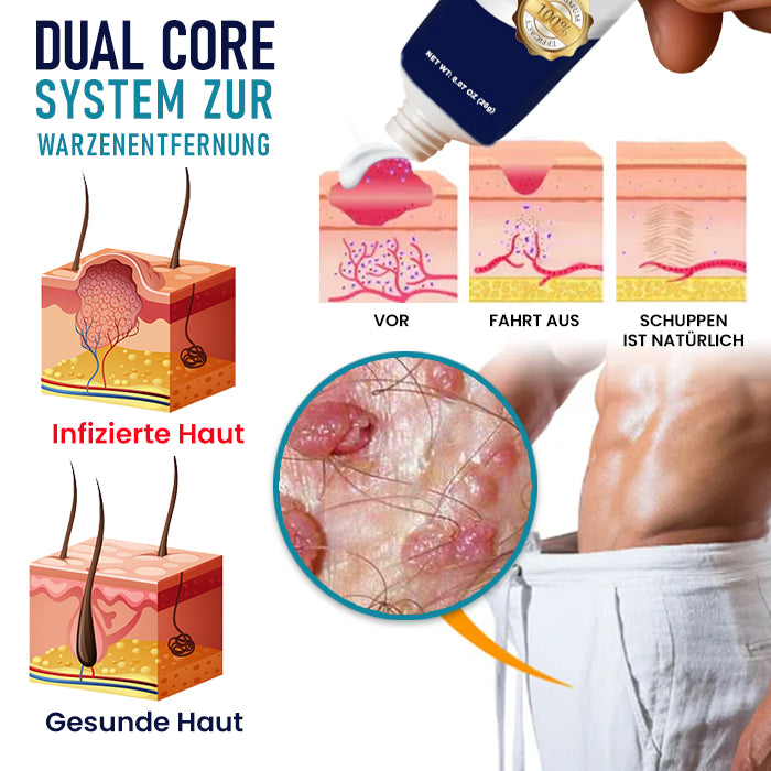 Cvreoz® Creme zur Entfernung von Genitalwarzen