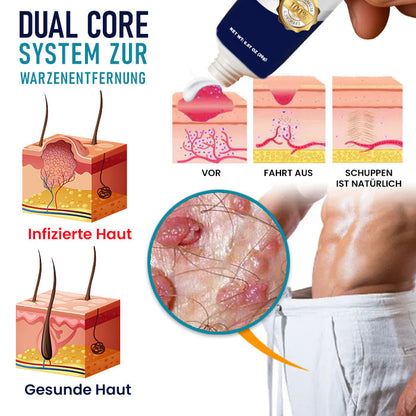 Cvreoz® Creme zur Entfernung von Genitalwarzen