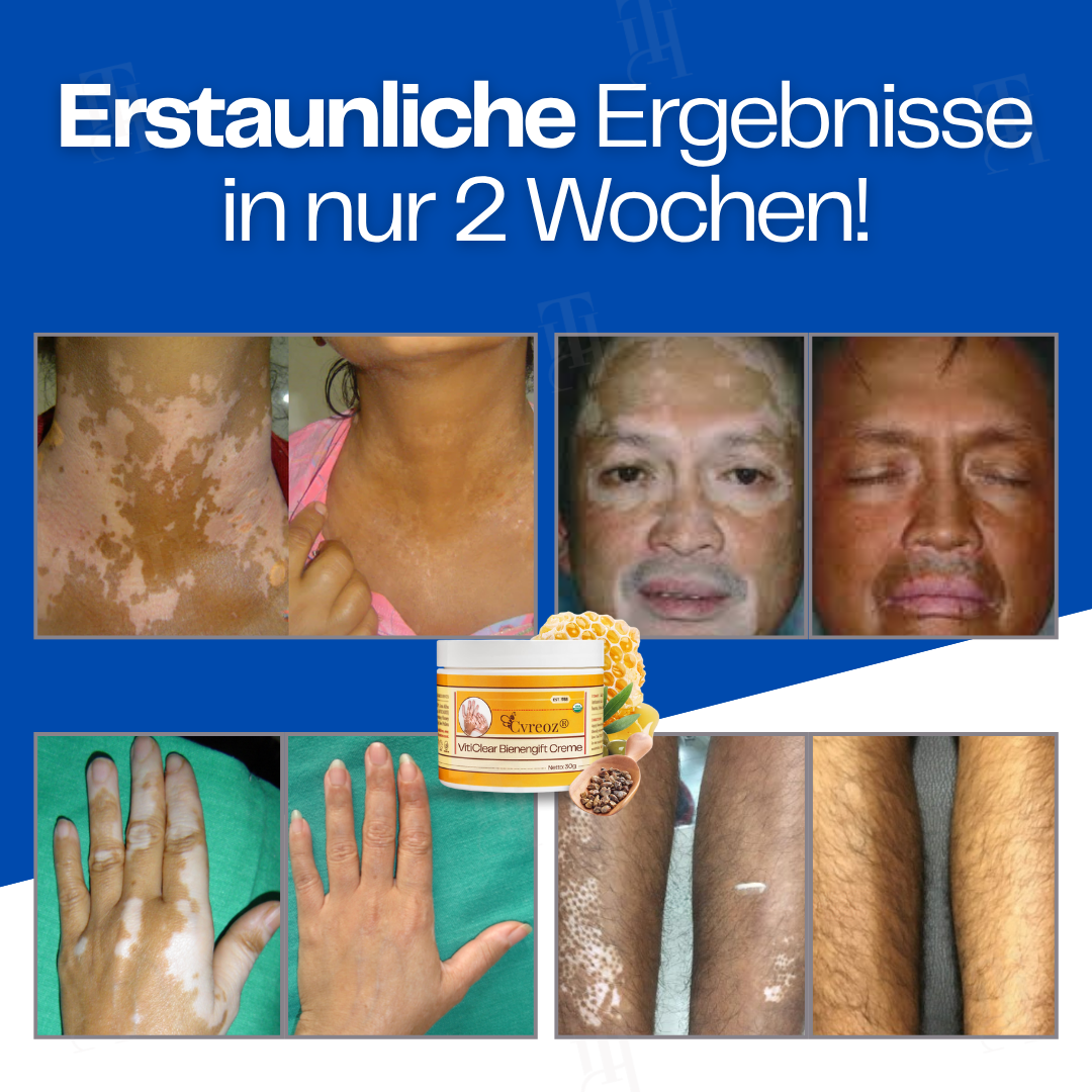 Nur noch 10 Stück übrig 🚀Cvreoz® VitiClear Bienengift Creme