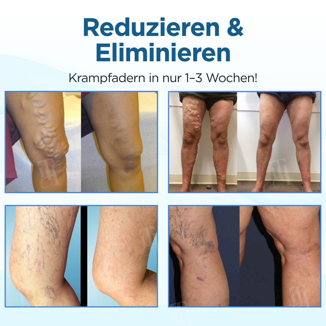 Cvreoz® Kräuter Krampfadern Behandlungsspray