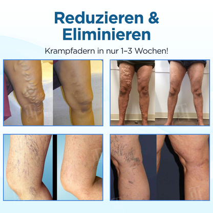 Cvreoz® Kräuter Krampfadern Behandlungsspray