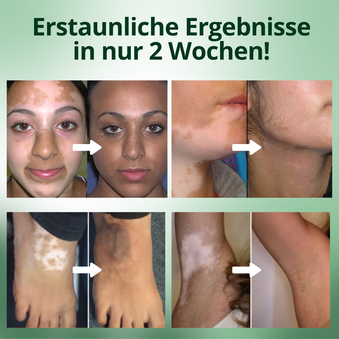 Cvreoz® Vitiligo Behandlung Creme