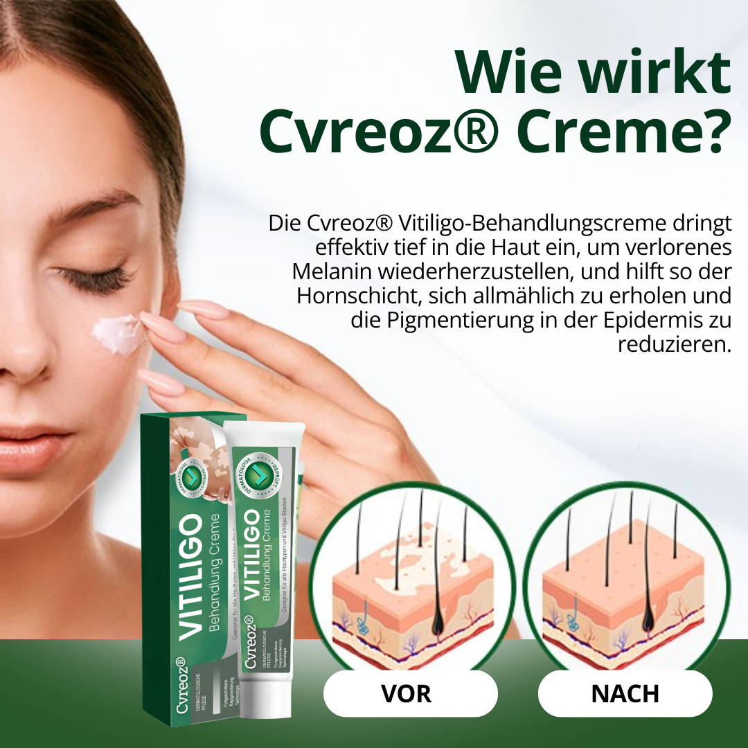 Cvreoz® Vitiligo Behandlung Creme