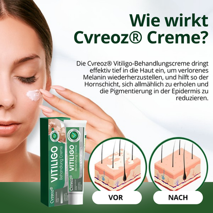 Cvreoz® Vitiligo Behandlung Creme